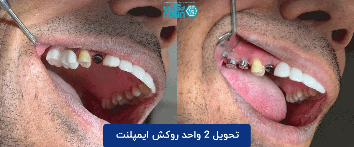 تجربه لبخند زیبا در کلینیک دندانپزشکی در شیراز
